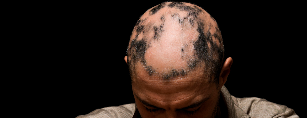 Alopecia (Saç Kıran)